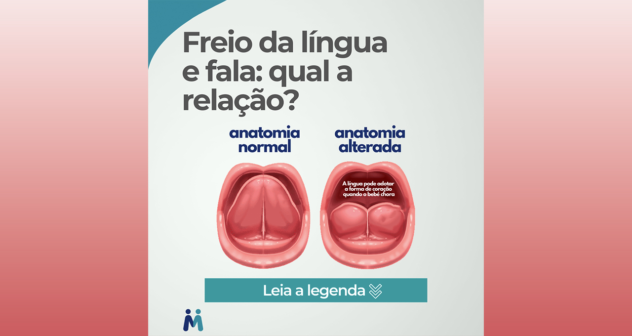 Freio Da Língua Rompido - RETOEDU